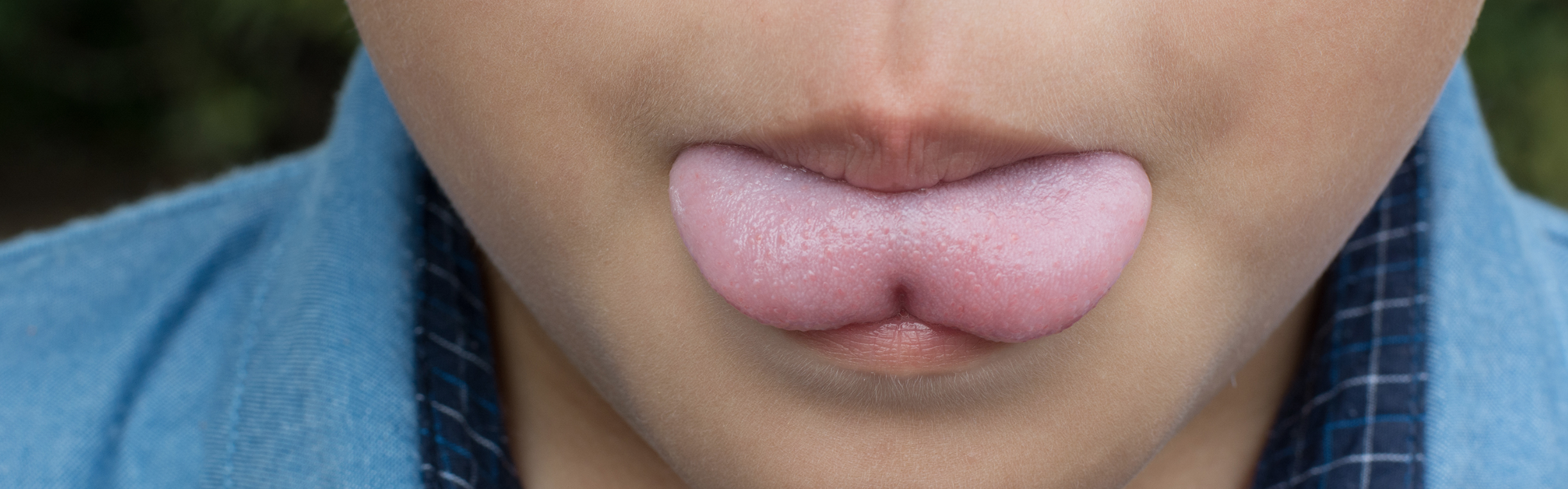 Hoog gehemelte en tongband